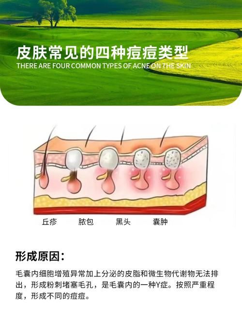 为什么香烟烫手会起疙瘩 为什么香烟烫手会起疙瘩呢