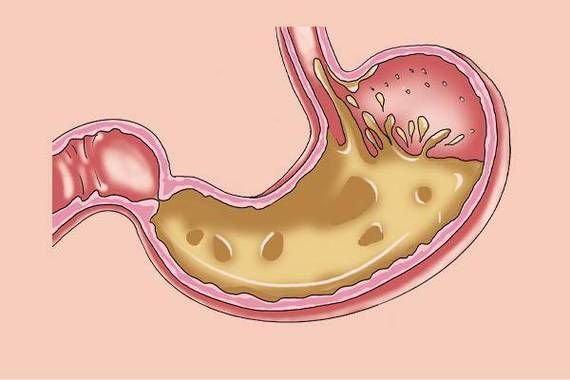 抽香烟反胃酸是什么原因 抽香烟反胃酸是什么原因引起的
